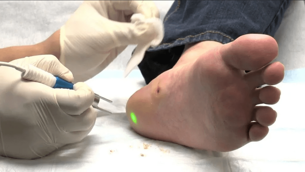 Tratamiento de la verruga plantar