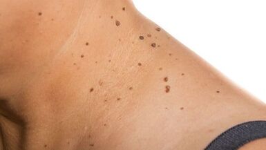 Cómo deshacerse del papiloma alrededor del cuello