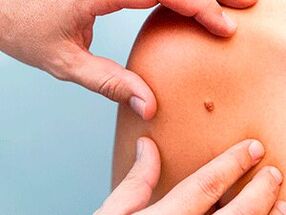 Razones de la aparición de papilomas en el cuerpo.