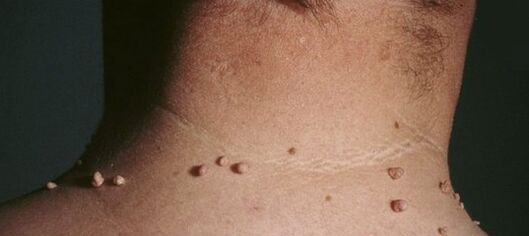 cómo deshacerse de los papilomas