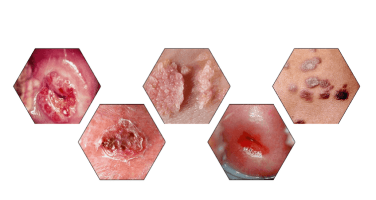 ¿Por qué son peligrosos los papilomas