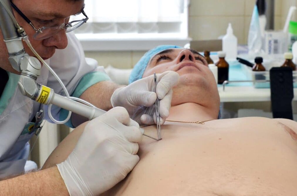 cómo deshacerse de las verrugas en el cuerpo