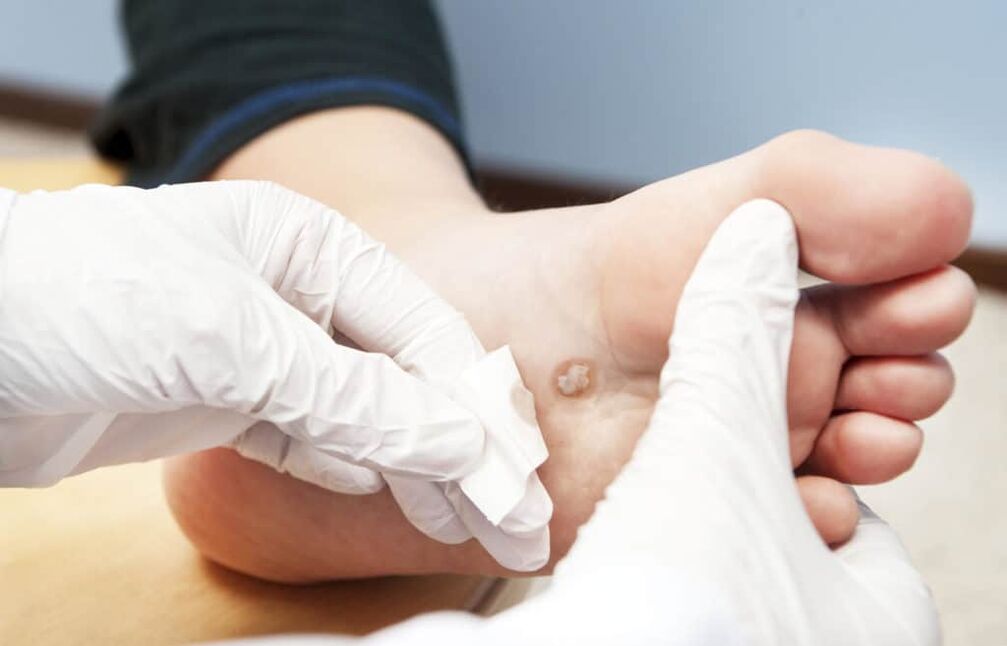 ¿Por qué aparecen verrugas en el cuerpo