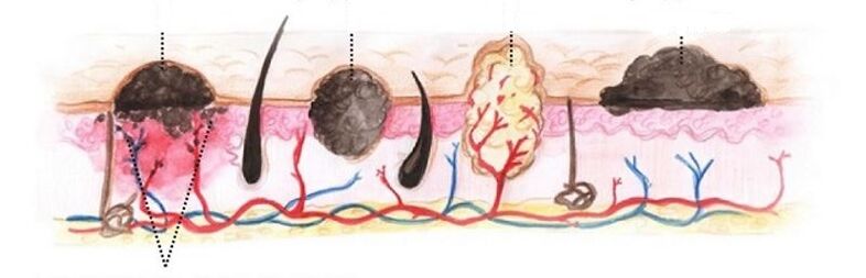 tipos de papilomas en el cuerpo humano