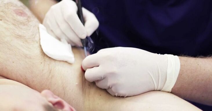Métodos profesionales para eliminar papilomas en el cuerpo humano.