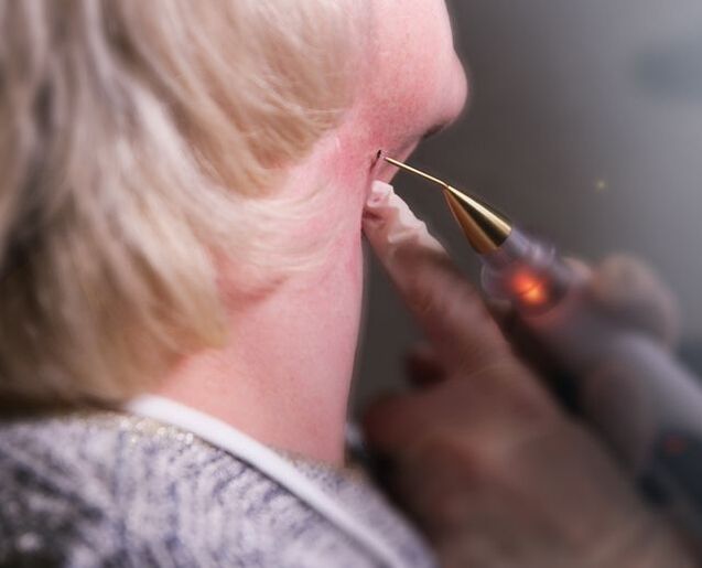 El proceso de extirpación del papiloma en el cuello de una mujer.