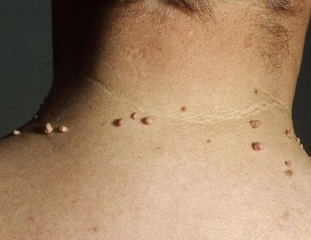 Papilomas en el cuello de un hombre.