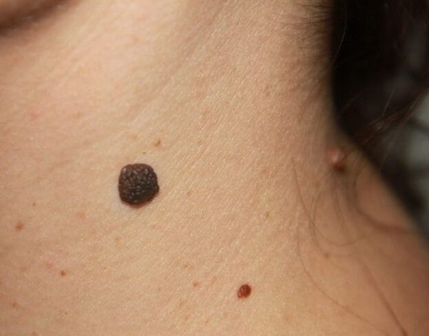 Papilomas planos en el cuello.