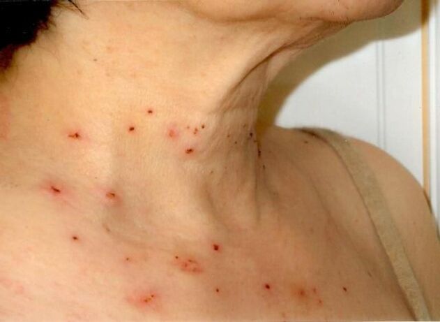 Resultados del tratamiento de papilomas en el cuello.