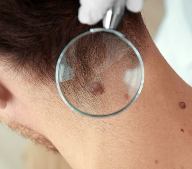 Un médico examina un papiloma en el cuello.