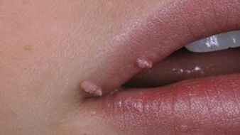 Papilomas en los labios.