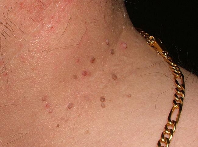 Papilomas en el cuello