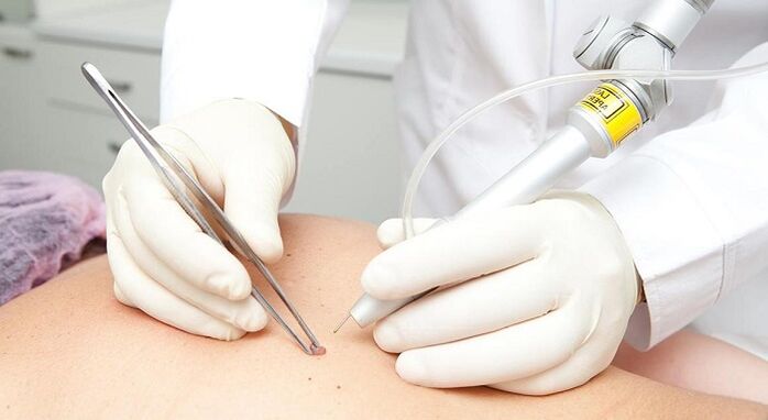 eliminación con láser de papiloma para el virus del papiloma